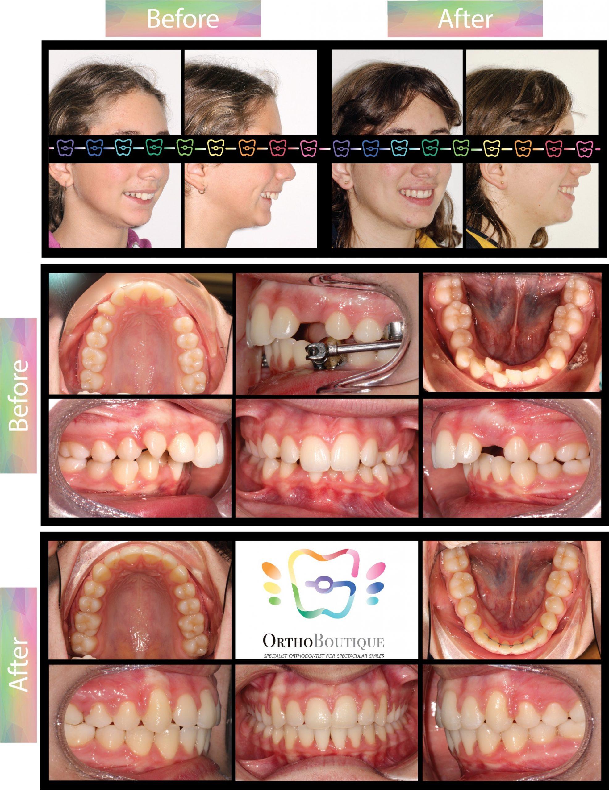 OrthoBoutique - CASE #14 Class II bite relationship, increased overjet, retrusive lower jaw position Before and after
