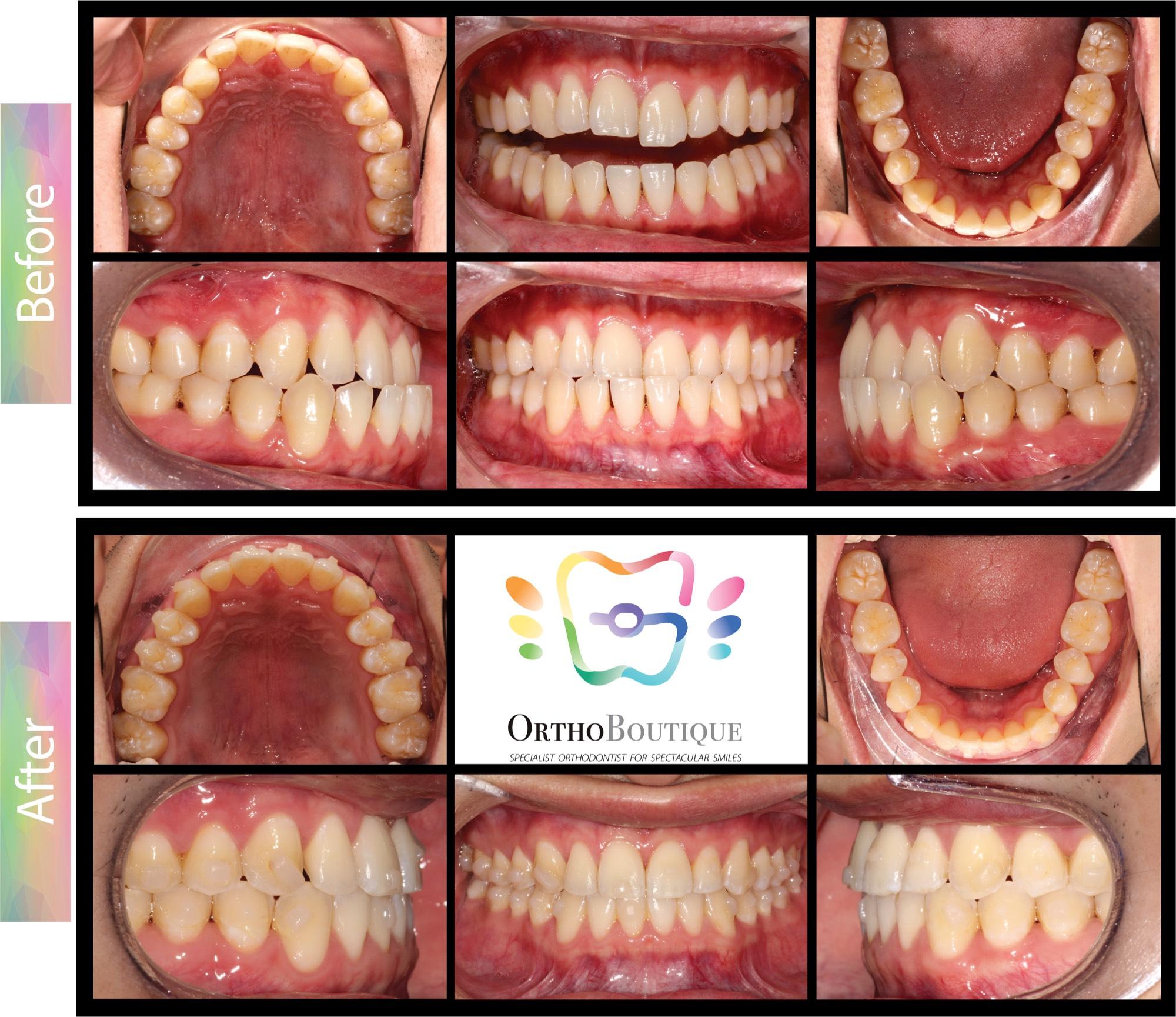 OrthoBoutique - CASE #16 Class III bite relationship, underbite, lower spacing Before and after