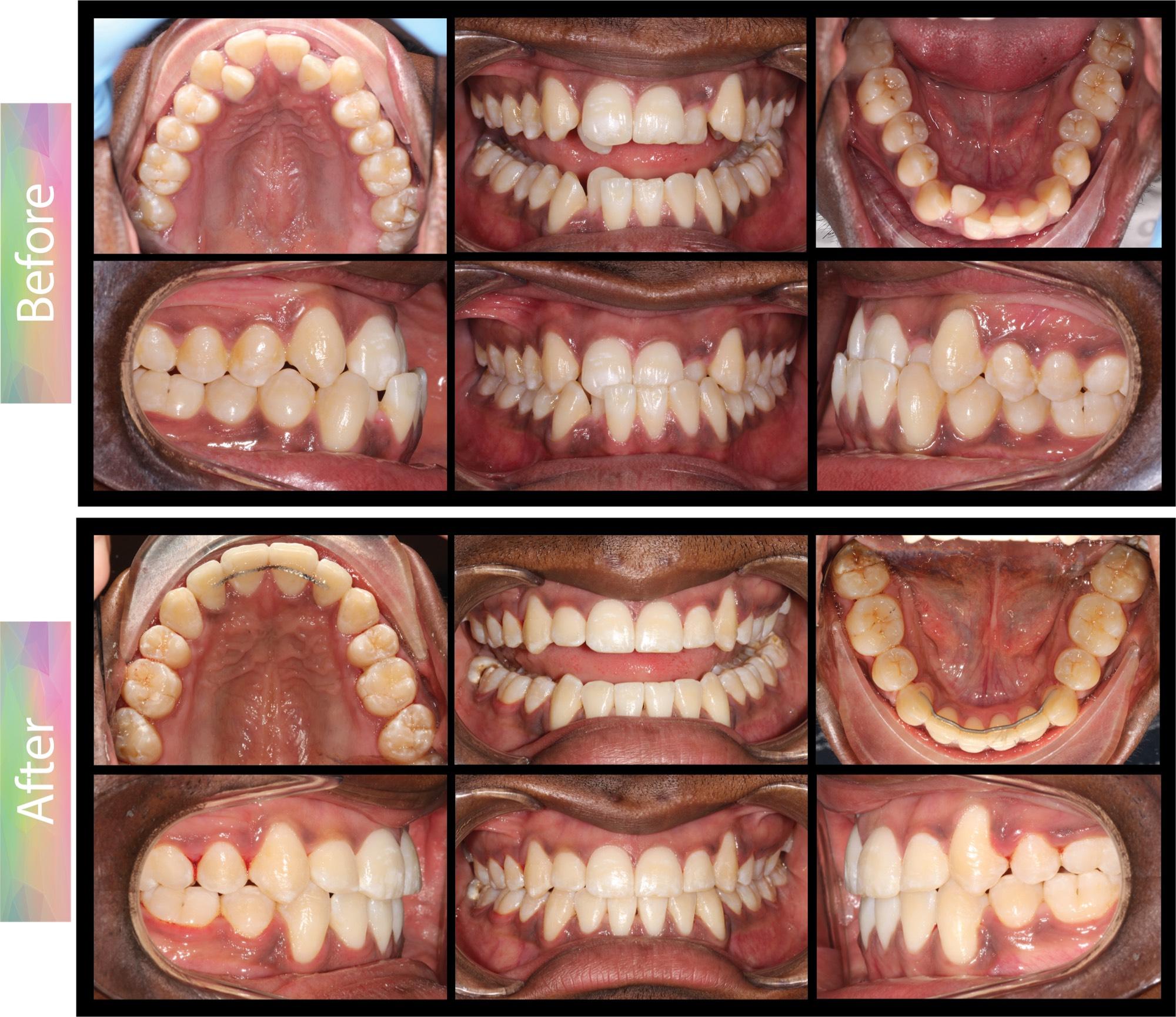 OrthoBoutique - CASE #17 Class III bite relationship, underbite, crowding Before and after