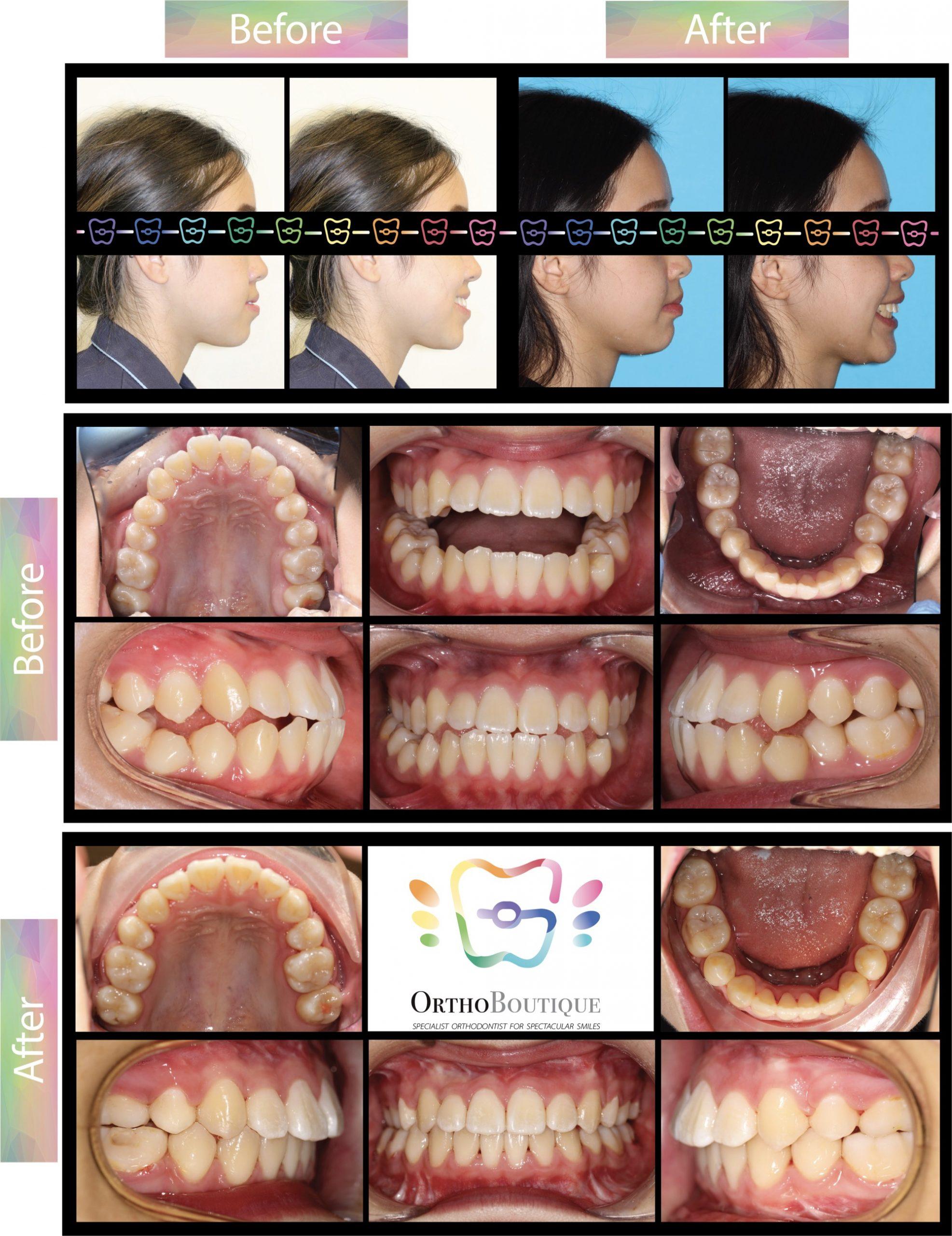 OrthoBoutique - CASE #18 Class III bite relationship, underbite, protrusive lower jaw position Before and after