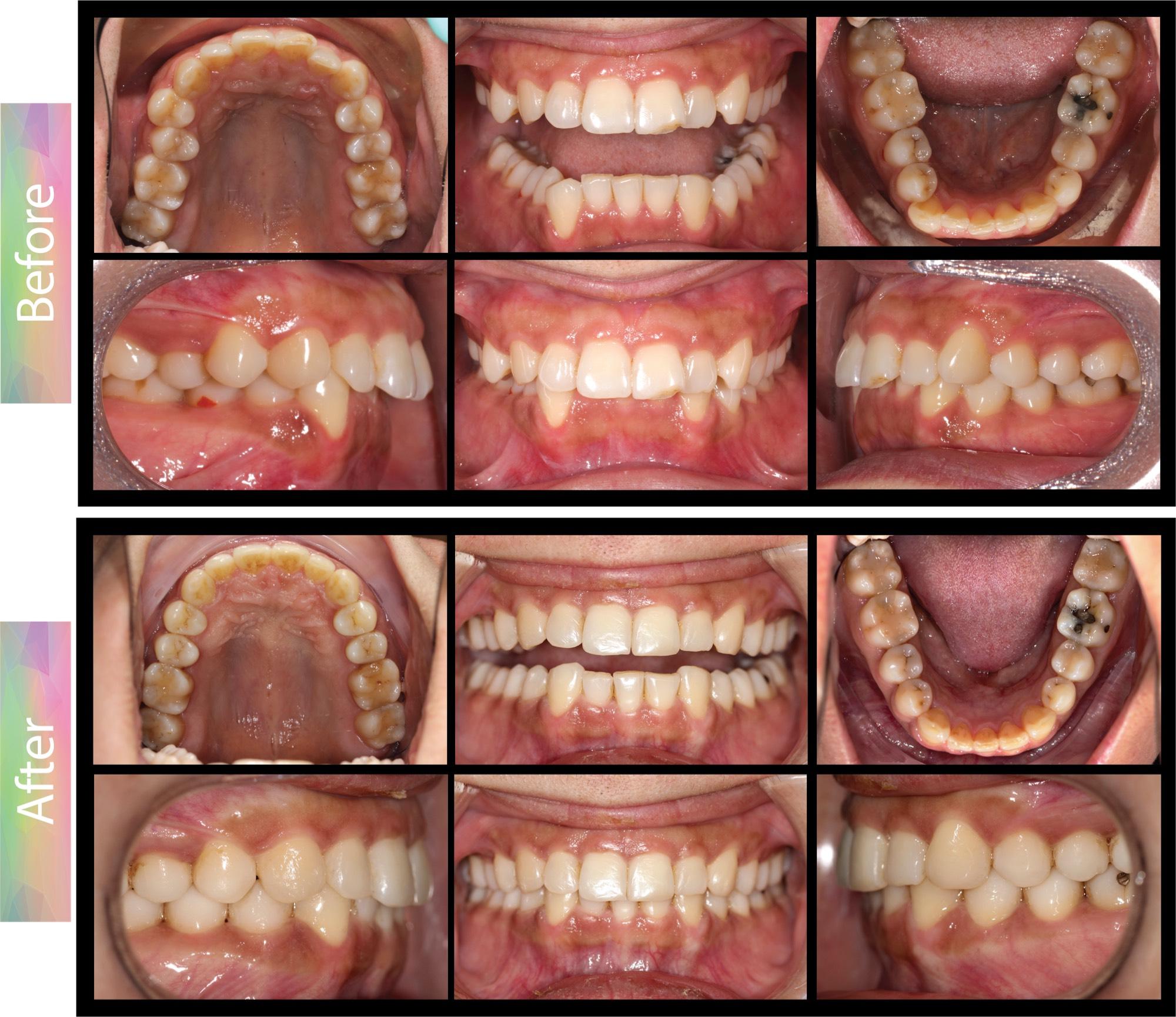 OrthoBoutique - CASE #8 Deep Overbite (missing one lower incisor) Before and After