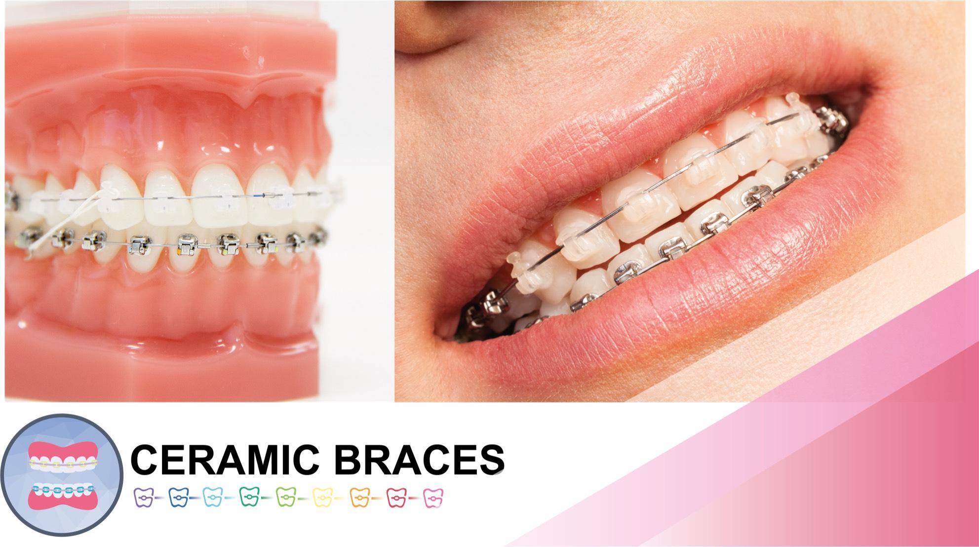 OrthoBoutique - a woman smiling wearing ceramic braces