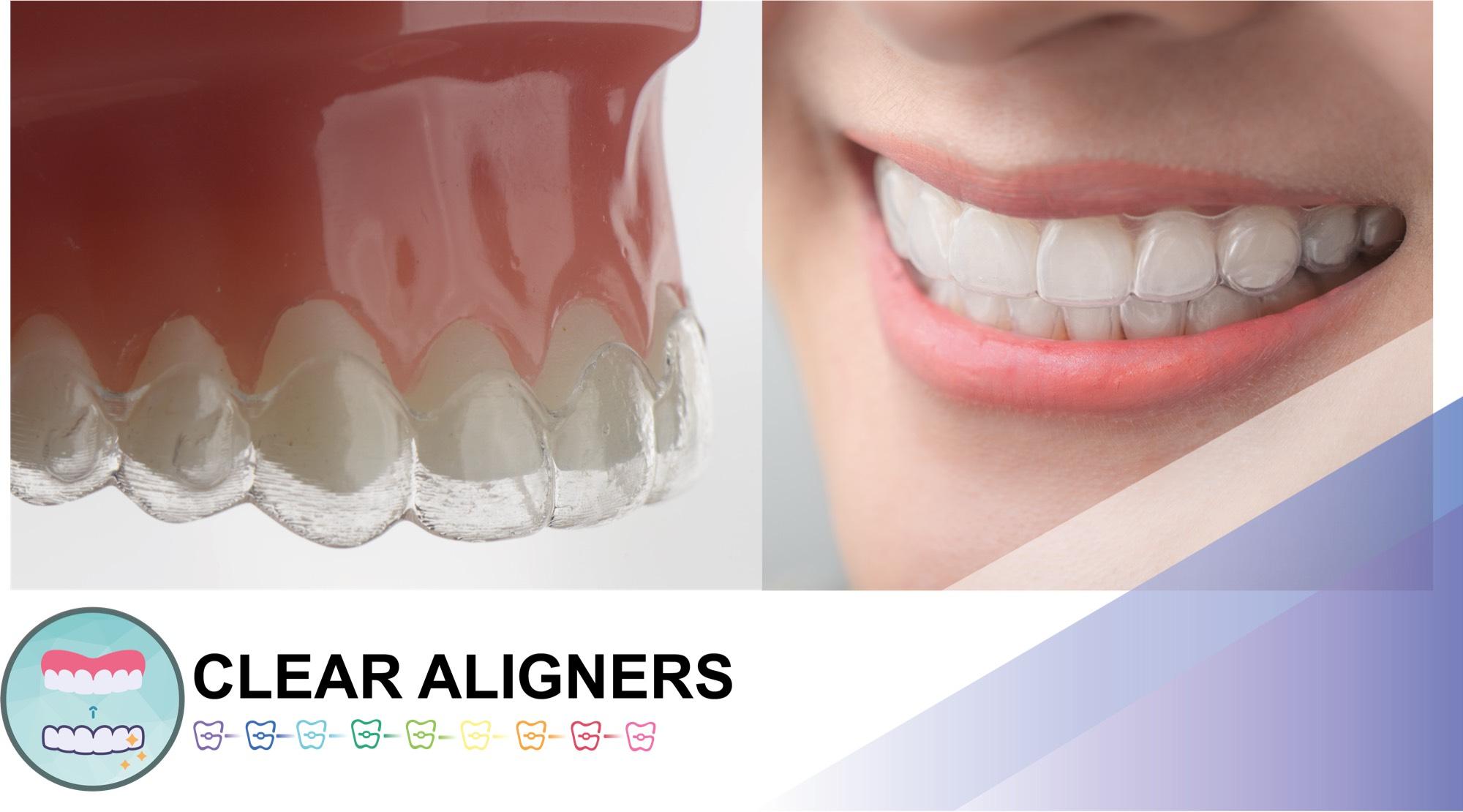 OrthoBoutique - a woman smiling wearing clear aligners