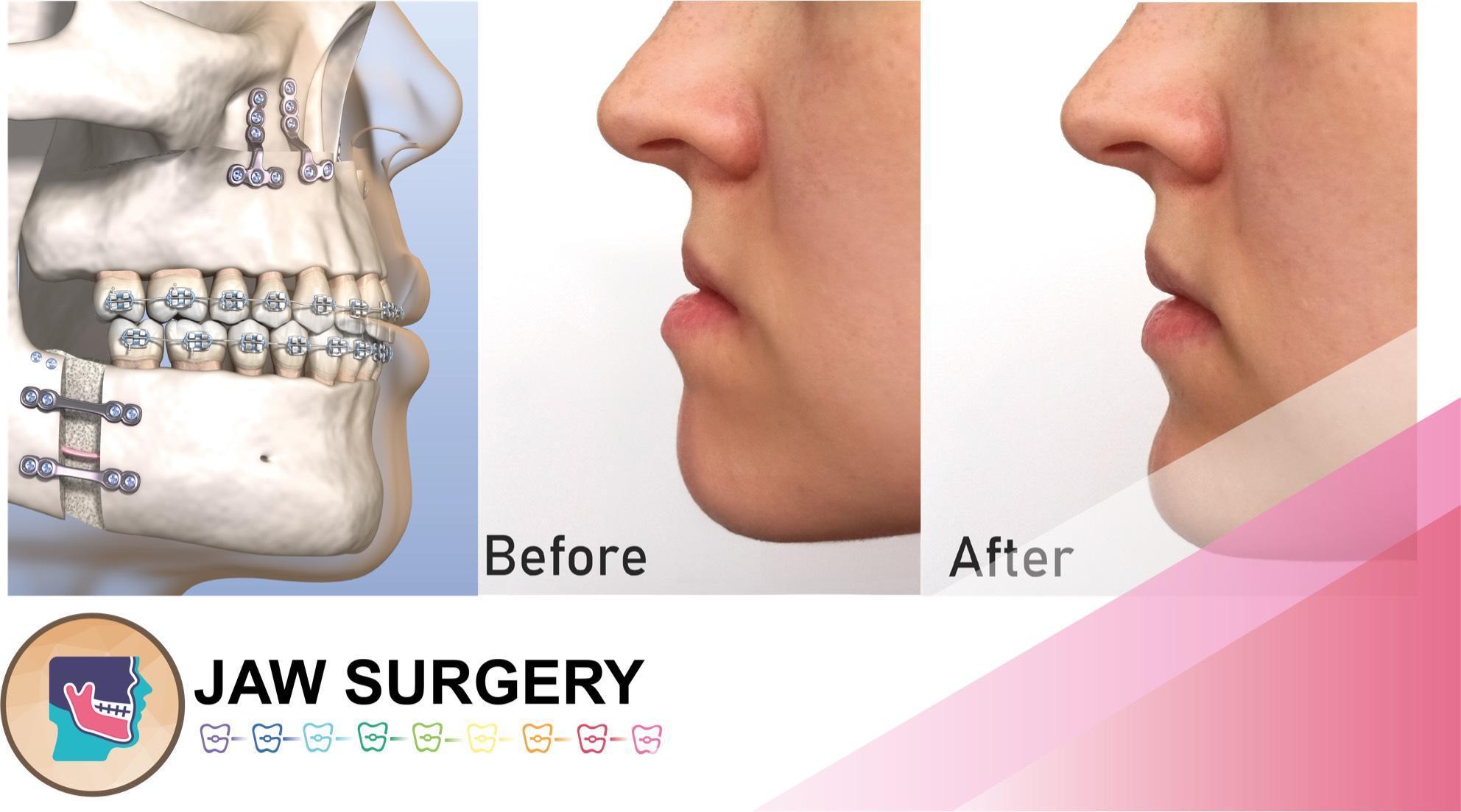 OrthoBoutique - before and after jaw surgery