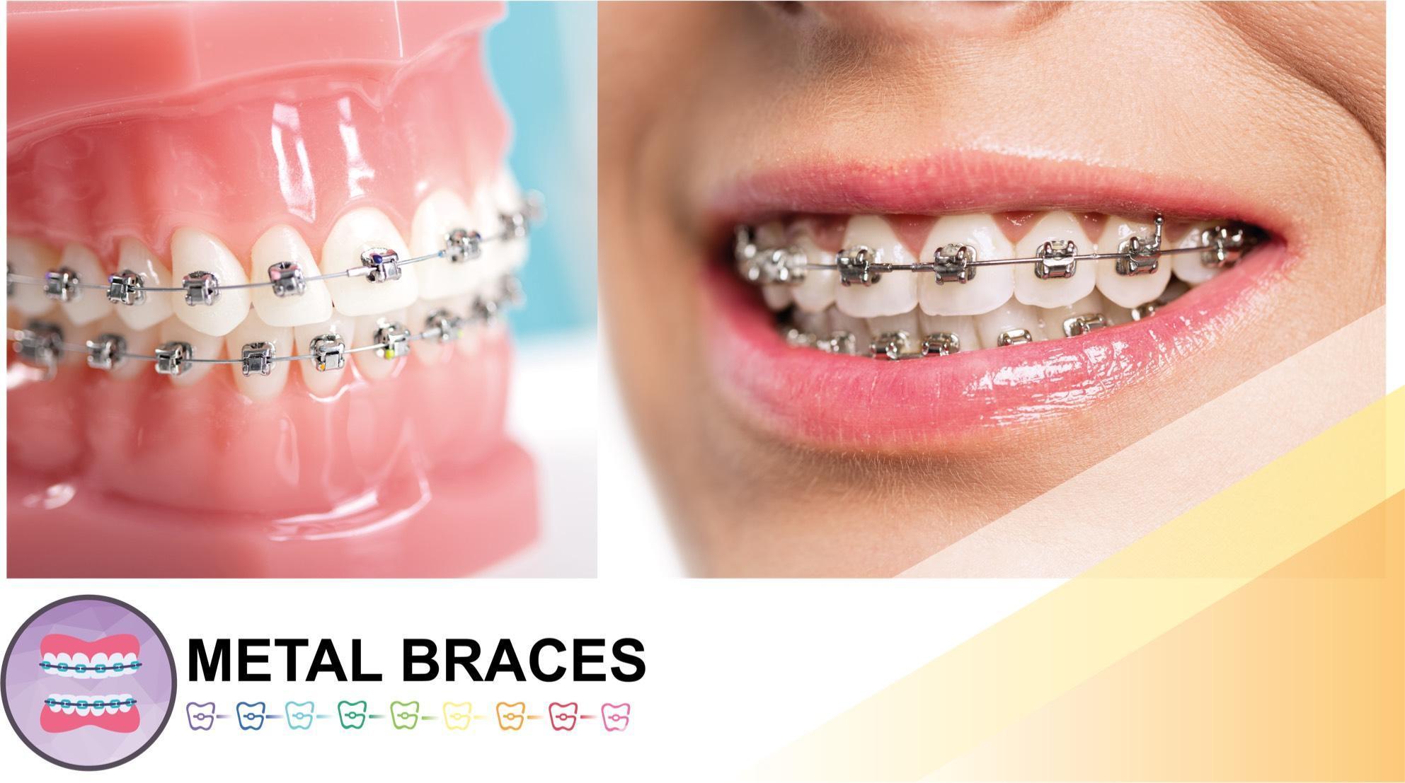OrthoBoutique - a woman smiling wearing metal braces